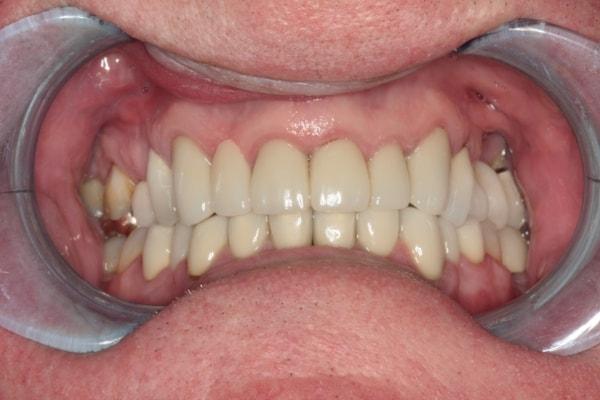 Harder Dental: Drs. Harder, Pham & Associates dental crowns after — Irvine, CA