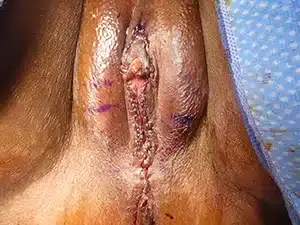 Elite Plastic Surgery labiaplasty after — Hollywood, FL