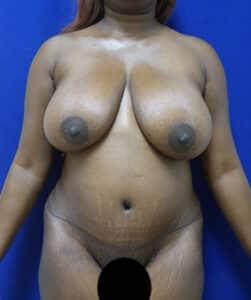 Elite Plastic Surgery tummy tuck after — Hollywood, FL