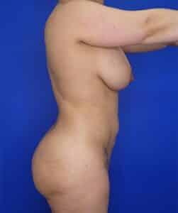 Elite Plastic Surgery bbl after — Hollywood, FL