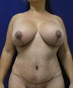 Elite Plastic Surgery tummy tuck after — Hollywood, FL