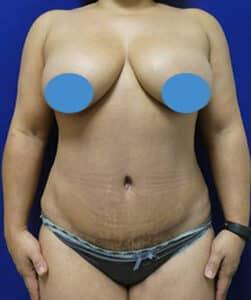Elite Plastic Surgery tummy tuck after — Hollywood, FL