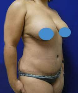 Elite Plastic Surgery tummy tuck after — Hollywood, FL