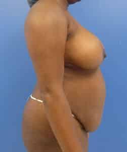 Tummy Tuck before at Elite Plastic Surgery in Hollywood, FL