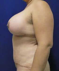 Elite Plastic Surgery tummy tuck after — Hollywood, FL