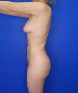 Elite Plastic Surgery bbl after — Hollywood, FL