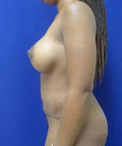 Elite Plastic Surgery tummy tuck after — Hollywood, FL