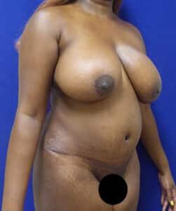 Elite Plastic Surgery tummy tuck after — Hollywood, FL