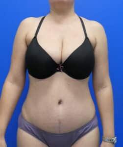 Elite Plastic Surgery tummy tuck after — Hollywood, FL
