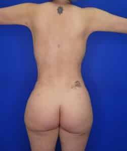 Elite Plastic Surgery bbl after — Hollywood, FL