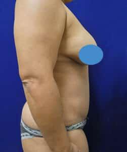 Elite Plastic Surgery tummy tuck after — Hollywood, FL