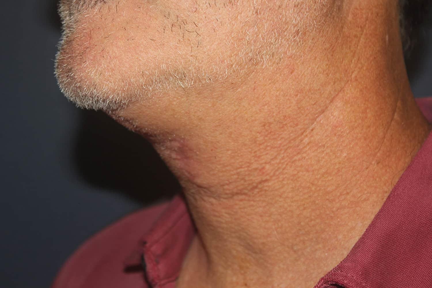Dr. David Bray Jr. neck lift after — Los Angeles, CA