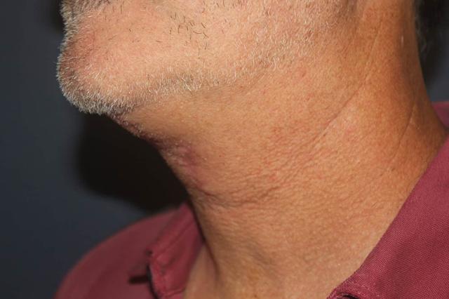 Neck Lift after at Dr. David Bray Jr. in Los Angeles, CA