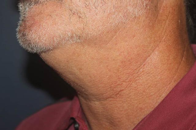 Neck Lift before at Dr. David Bray Jr. in Los Angeles, CA