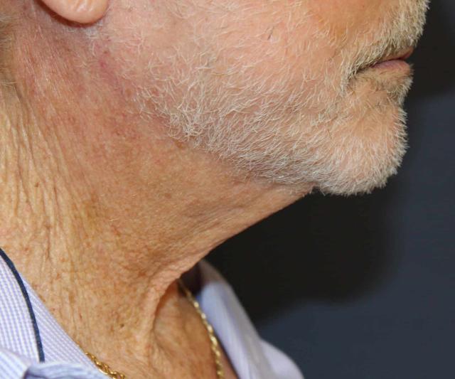 Facelift after at Dr. David Bray Jr. in Los Angeles, CA