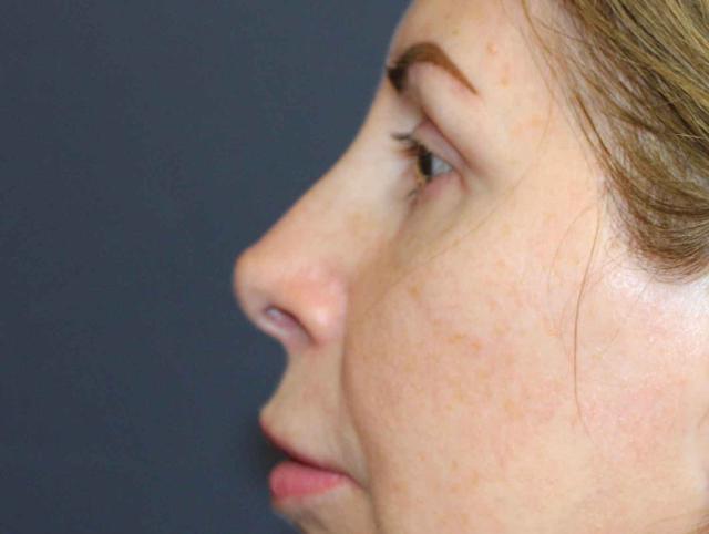 Rhinoplasty after at Dr. David Bray Jr. in Los Angeles, CA