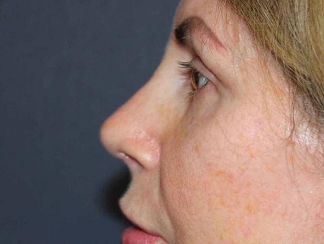 Rhinoplasty before at Dr. David Bray Jr. in Los Angeles, CA