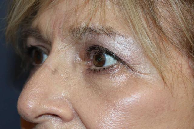Blepharoplasty after at Dr. David Bray Jr. in Los Angeles, CA