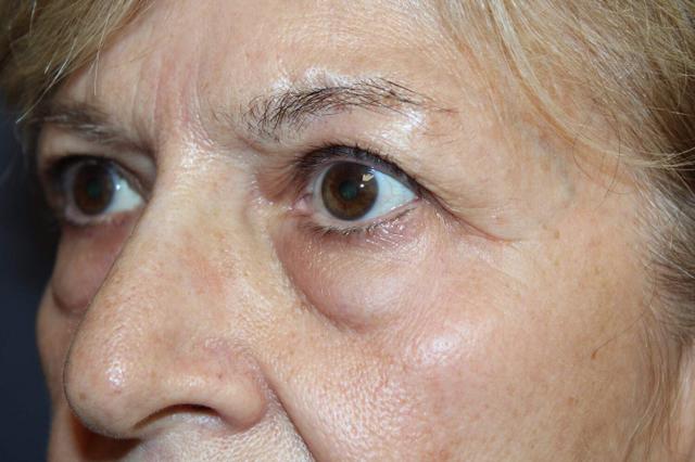 Blepharoplasty before at Dr. David Bray Jr. in Los Angeles, CA