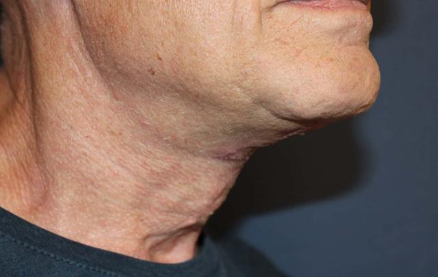 Neck Lift after at Dr. David Bray Jr. in Los Angeles, CA