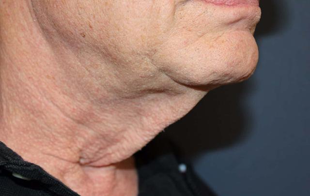 Neck Lift before at Dr. David Bray Jr. in Los Angeles, CA