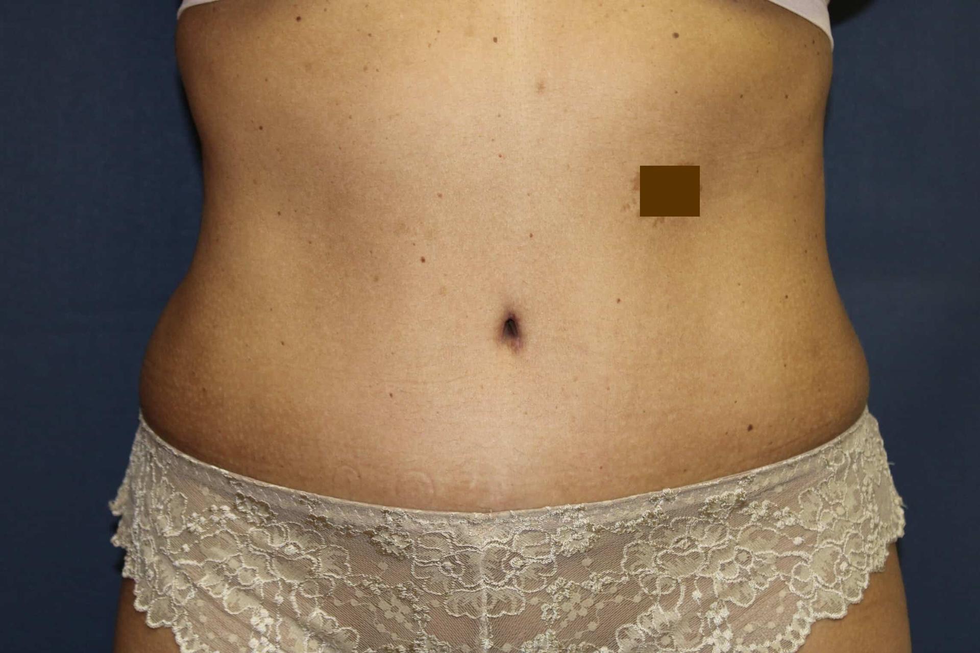 Dr. David Bray Jr. tummy tuck after — Torrance, CA