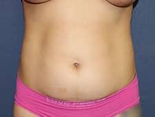 Tummy Tuck before at Dr. David Bray Jr. in Los Angeles, CA