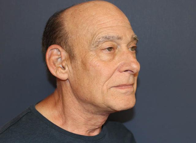 Neck Lift after at Dr. David Bray Jr. in Los Angeles, CA