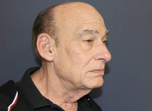 Neck Lift before at Dr. David Bray Jr. in Los Angeles, CA