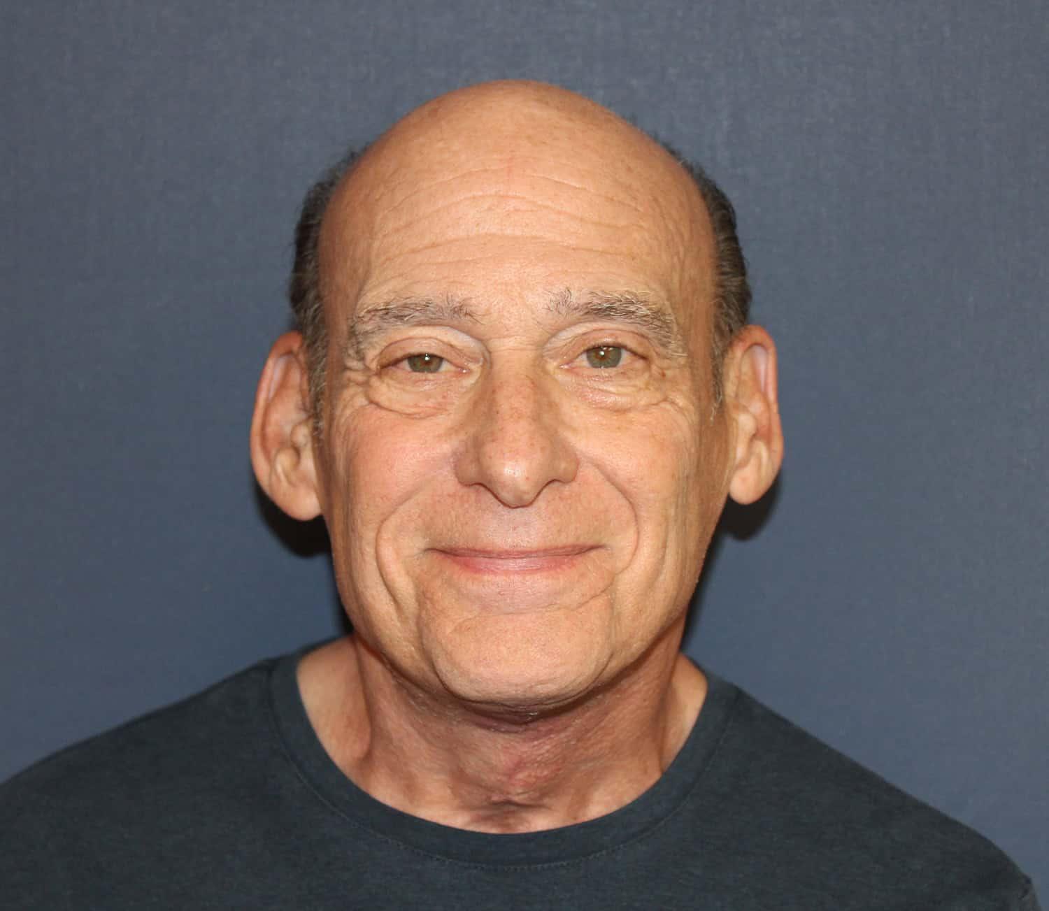 Dr. David Bray Jr. neck lift after — Los Angeles, CA