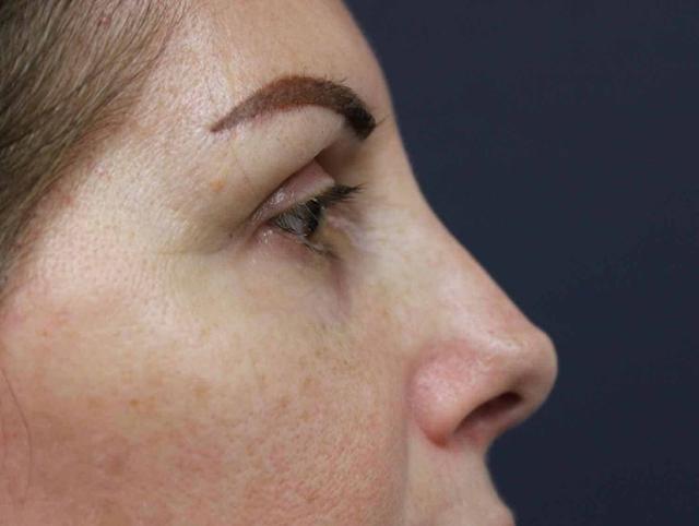 Rhinoplasty after at Dr. David Bray Jr. in Los Angeles, CA