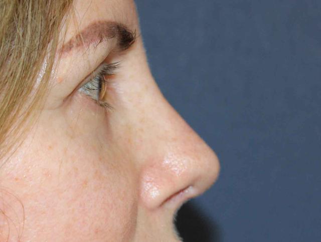 Rhinoplasty before at Dr. David Bray Jr. in Los Angeles, CA