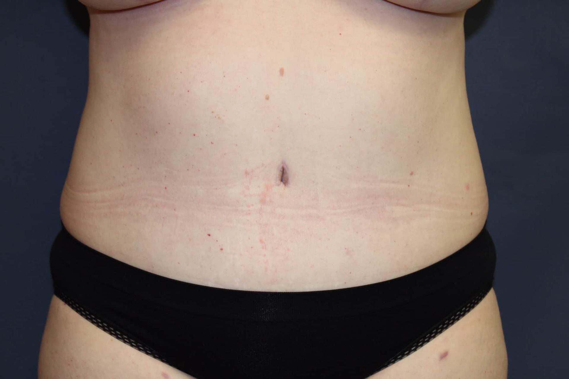 Dr. David Bray Jr. tummy tuck after — Torrance, CA