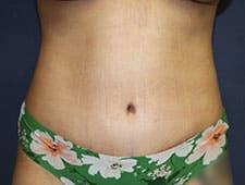 Tummy Tuck after at Dr. David Bray Jr. in Los Angeles, CA