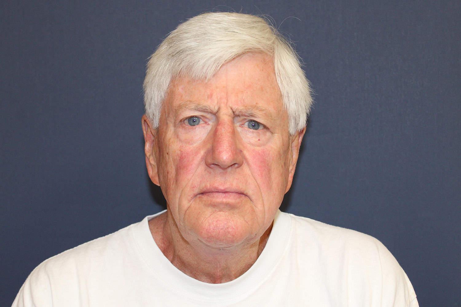 Dr. David Bray Jr. neck lift after — Los Angeles, CA