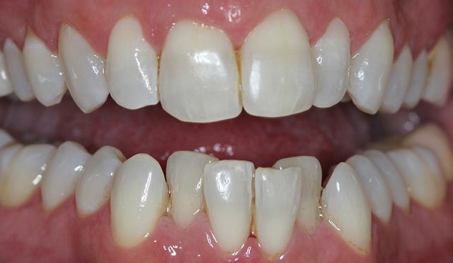 Invisalign before at Nashville Restorative Dentistry in Franklin, TN