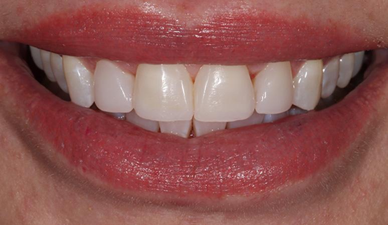 Nashville Restorative Dentistry veneers after — Franklin, TN