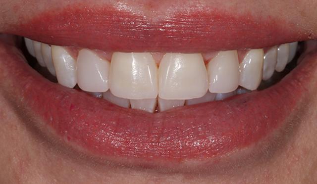 Dental Veneers after at Nashville Restorative Dentistry in Franklin, TN