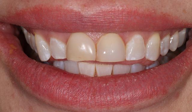 Dental Veneers before at Nashville Restorative Dentistry in Franklin, TN