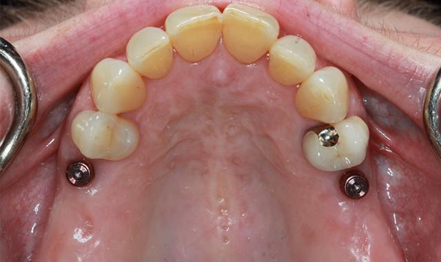 Smile Makeover before at Nashville Restorative Dentistry in Franklin, TN