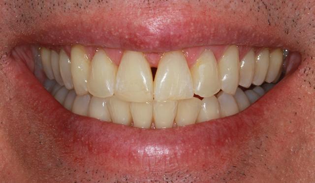 Invisalign after at Nashville Restorative Dentistry in Franklin, TN