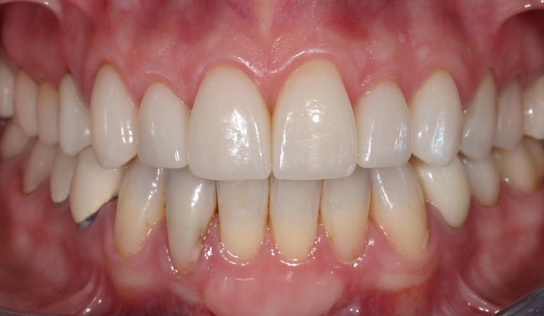 Nashville Restorative Dentistry veneers after — Franklin, TN