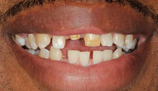 Invisalign before at Nashville Restorative Dentistry in Franklin, TN