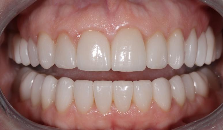 Nashville Restorative Dentistry veneers after — Franklin, TN