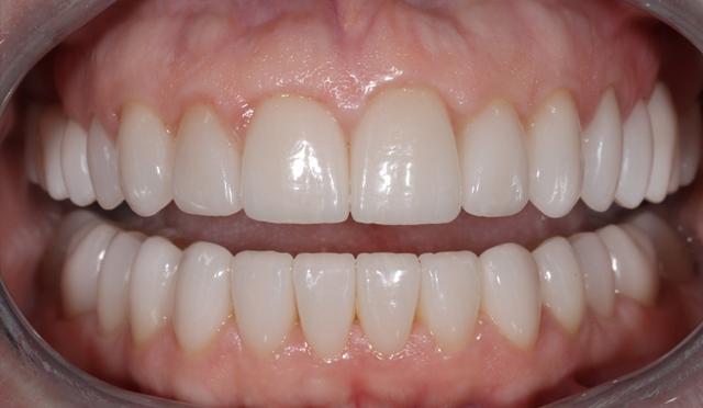 Dental Veneers after at Nashville Restorative Dentistry in Franklin, TN
