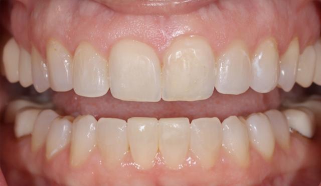 Dental Veneers before at Nashville Restorative Dentistry in Franklin, TN