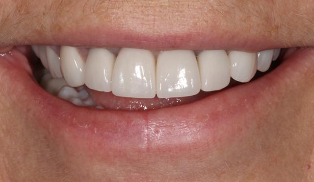 Invisalign after at Nashville Restorative Dentistry in Franklin, TN