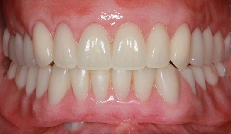 Nashville Restorative Dentistry smile makeover after — Franklin, TN