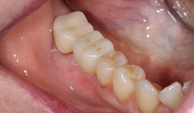 Nashville Restorative Dentistry smile makeover after — Franklin, TN