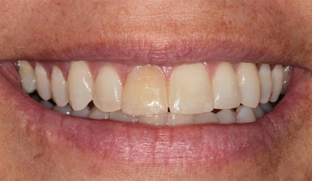 Teeth Whitening before at Nashville Restorative Dentistry in Franklin, TN